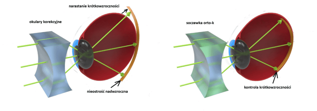 OrtoKorekcja Opticon CDW
